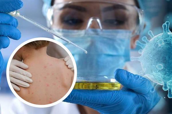 khu-vuc-my-latinh-ghi-nhan-ca-mac-dau-mua-khi-dau-tien-2 Tiêu điểm thế giới - Khu vực Mỹ Latinh ghi nhận ca mắc đậu mùa khỉ đầu tiên